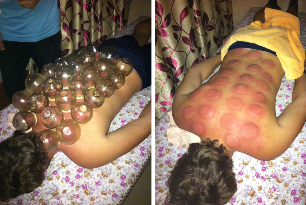 cupping